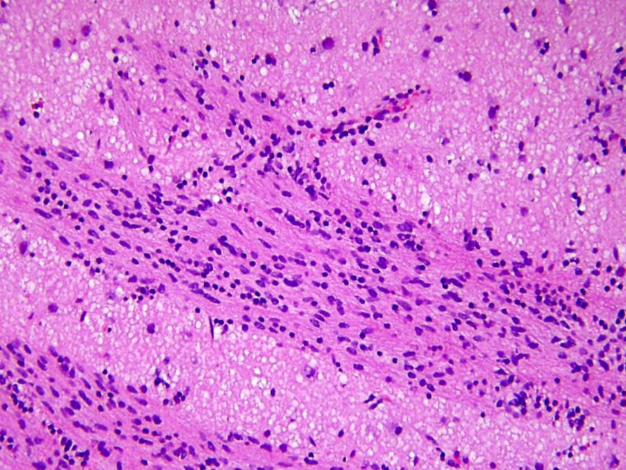 H&E Stain of an Anaplastic Astro