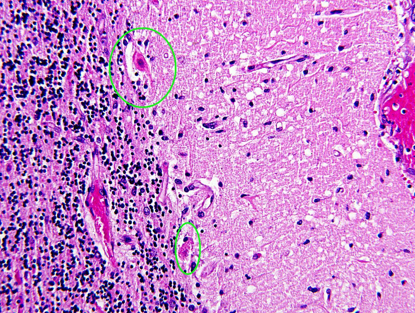 Acute neuronal necrosis cerebell