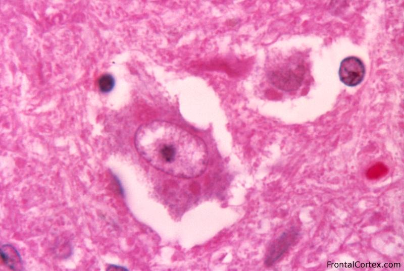 	Photomicrograph of H&E stained brain tissue from a rabies encephalitis patient.