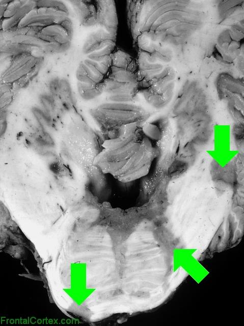 Multiple sclerosis, transverse section through pons and cerebellum with arrows