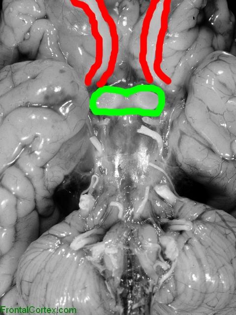 Krabbe disease, ventral surface of brain, highlighted