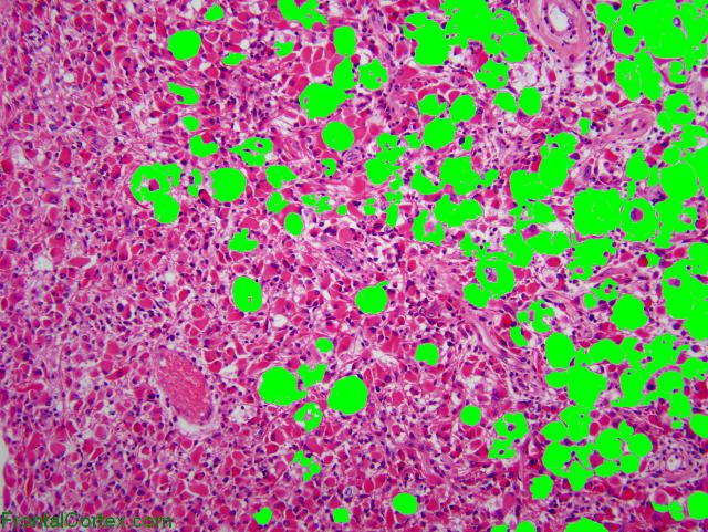 Lipoastrocytoma, H&E stain x100, labeled
