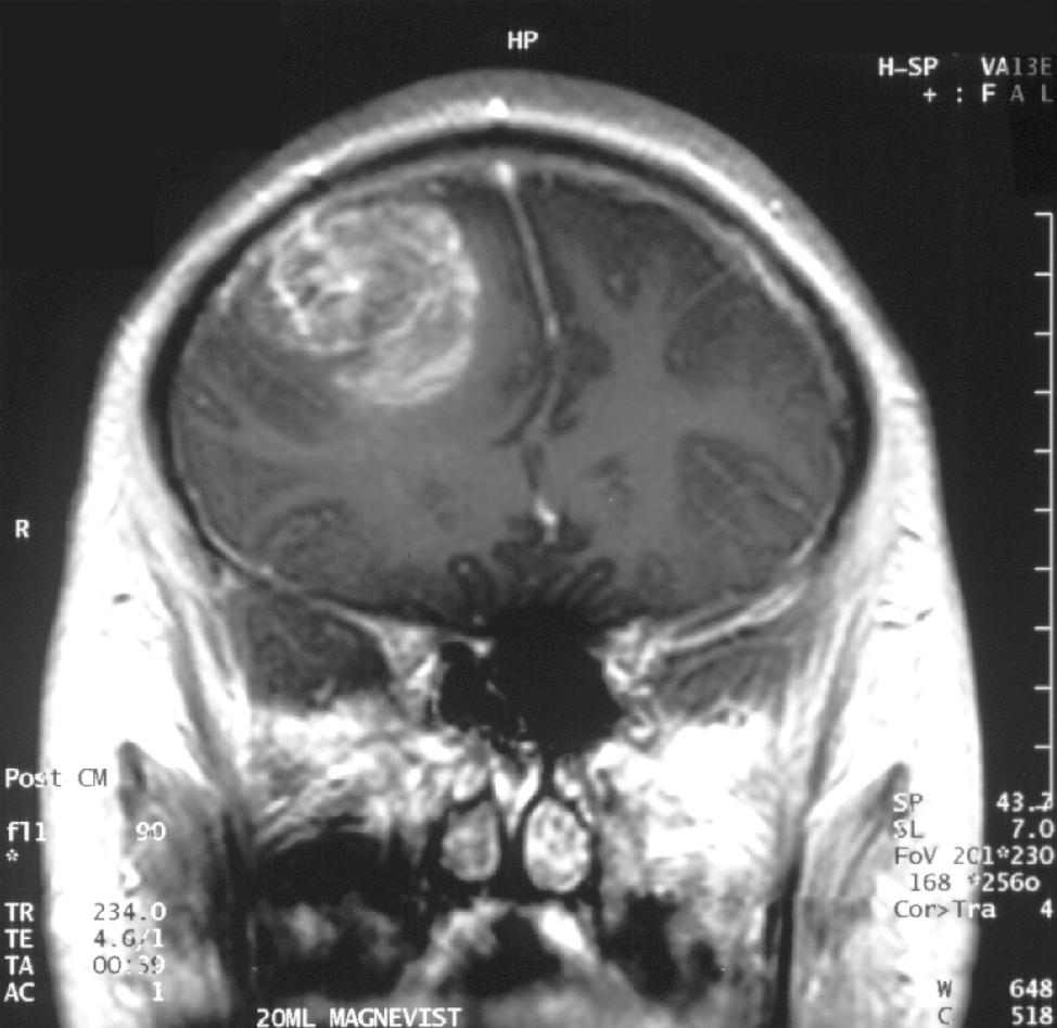 GBM - MRI with contrast