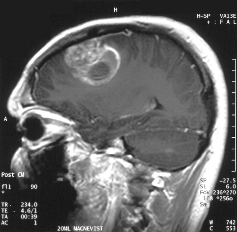 GBM - MRI with contrast sagittal