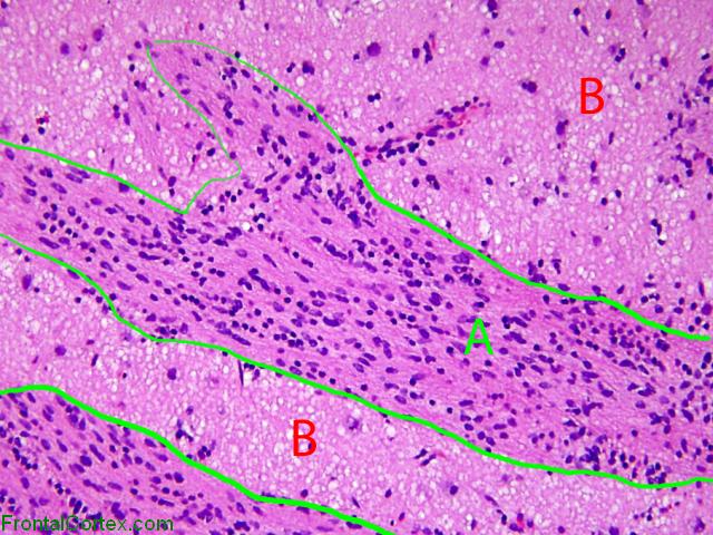 Anaplastic astrocytoma infiltrating corpus striatum, H&E stain x 200, labeled