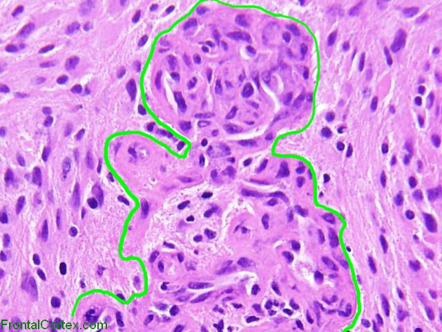 Glioblastoma multiforme, microvascular proliferation, H&E stain x 400, labeled