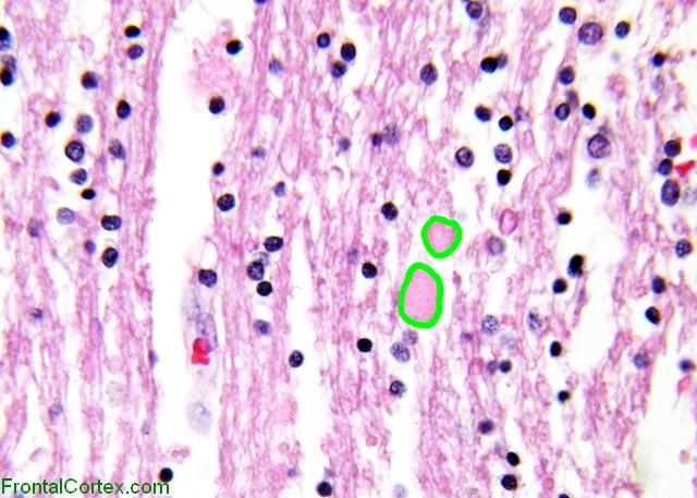 Vanishing white matter disease, H&E stain, 200 X magnification, labeled