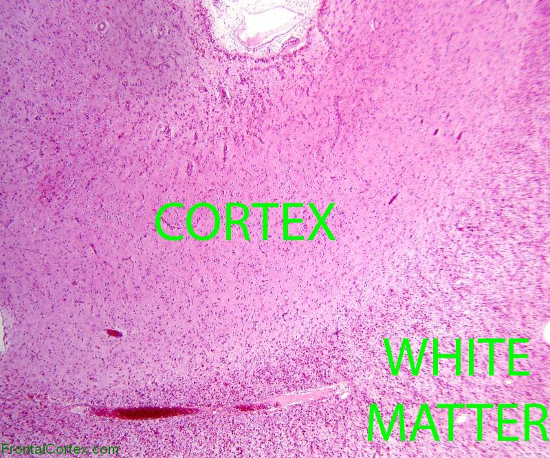 Alexander Disease, cerebral cortex and white matter, H&E stained section, 20X magnification, labeled