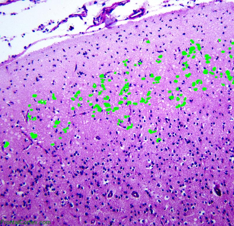 Canavan disease, high powered PAS stained section of cerebral cortex, labeled