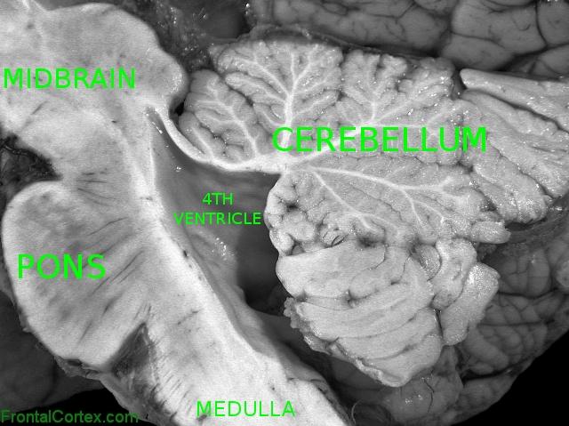 Sagittal gross section of normal midbrain