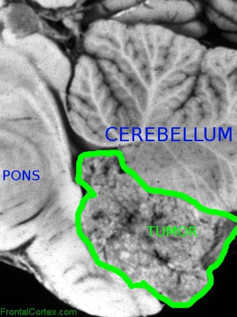 fourth ventricular ependymoma, sagittal section through brainstem and cerebellum, labeled