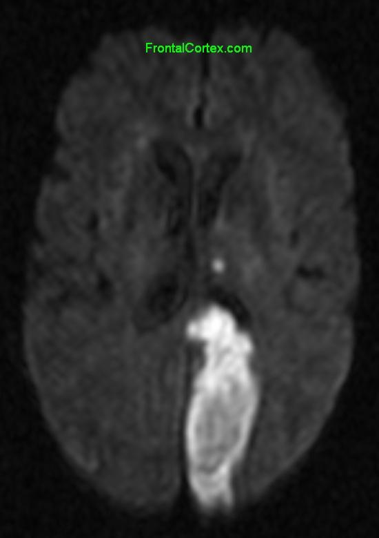 For Comparison, MRI DWI - Acute Left PCA Infarct