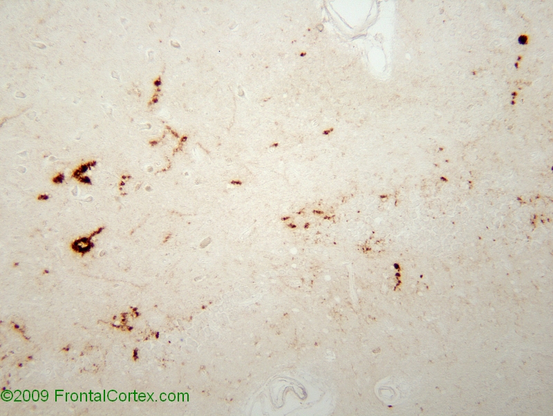 Type 2 prion disease, immunohistochemical stains sectioned from hippocampus.