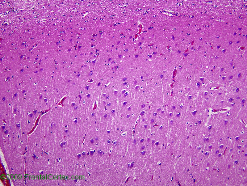 Type 1 prion hippocampus H&E