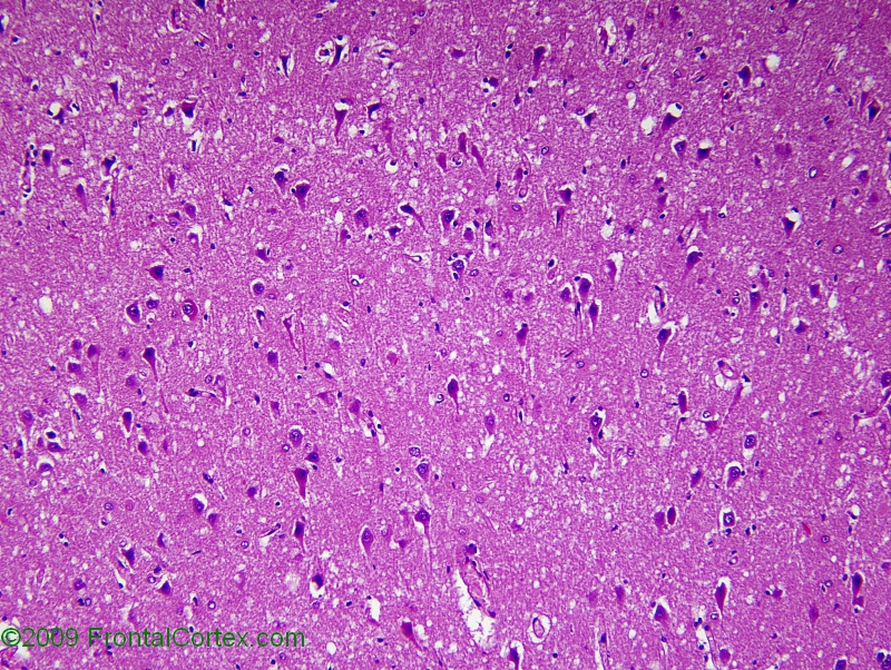 Type 2 prion disease, H&E stained section of hippocampus.