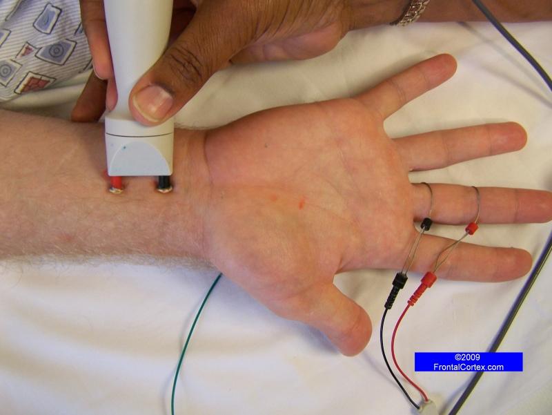 NCS Median wrist-palm segmental study