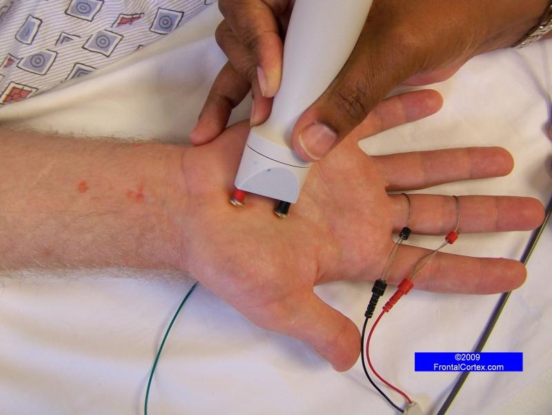 NCS Median wrist-palm segmental study 2