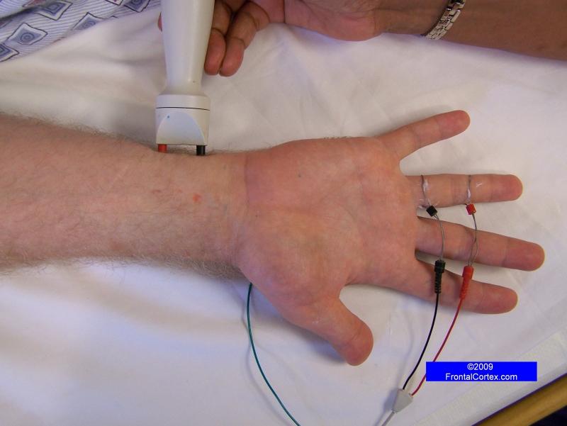 Ulnar Sensory Nerve - Recording the ring finger (antidromic)