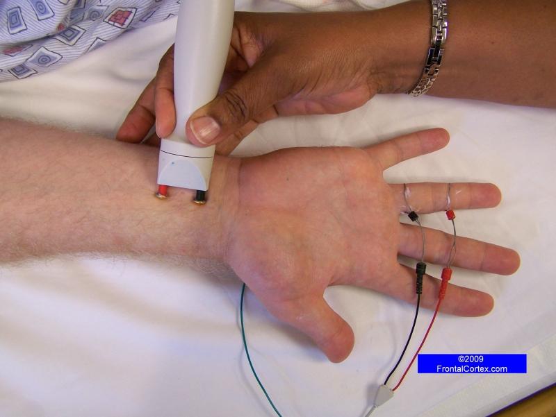 Median Sensory Nerve - Recording the ring finger (antidromic)