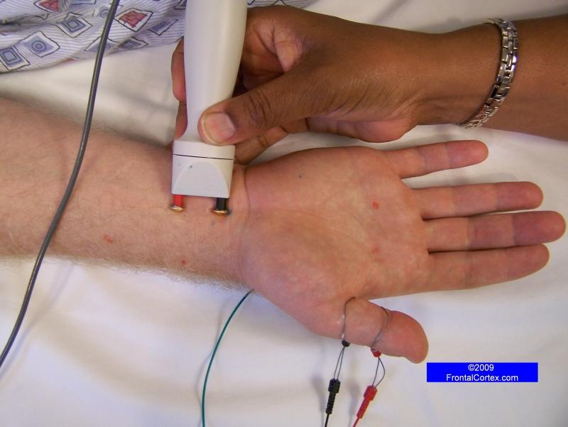 Median Sensory Nerve Conduction Study - Recording the thumb (antidromic)