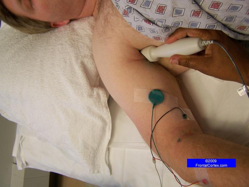 Musculocutaneous Motor Nerve Conduction Study - recording the Biceps, Stimulating at Axilla