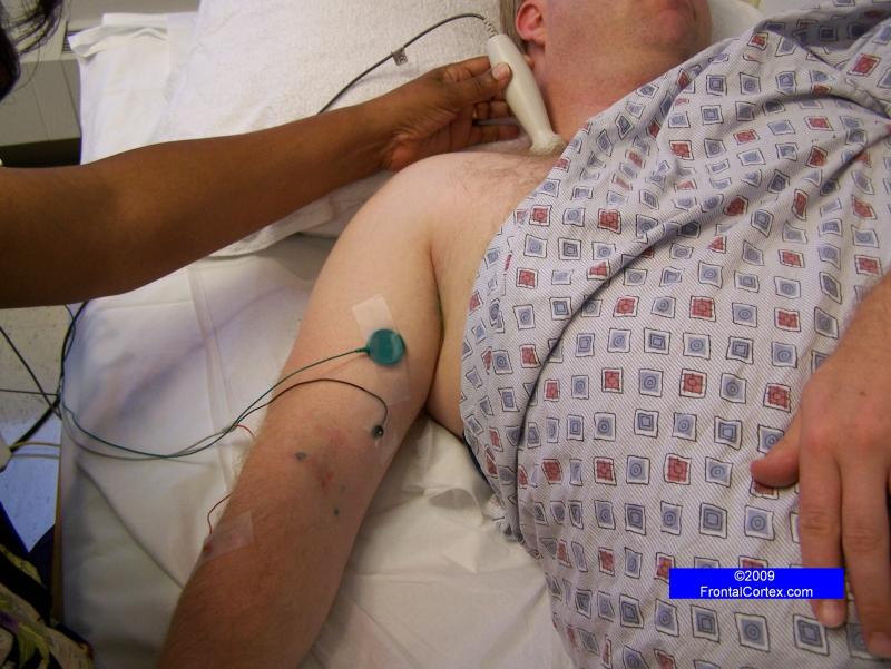 Musculocutaneous Motor Nerve Conduction Study - recording the Biceps, Stimulating at Erb's point