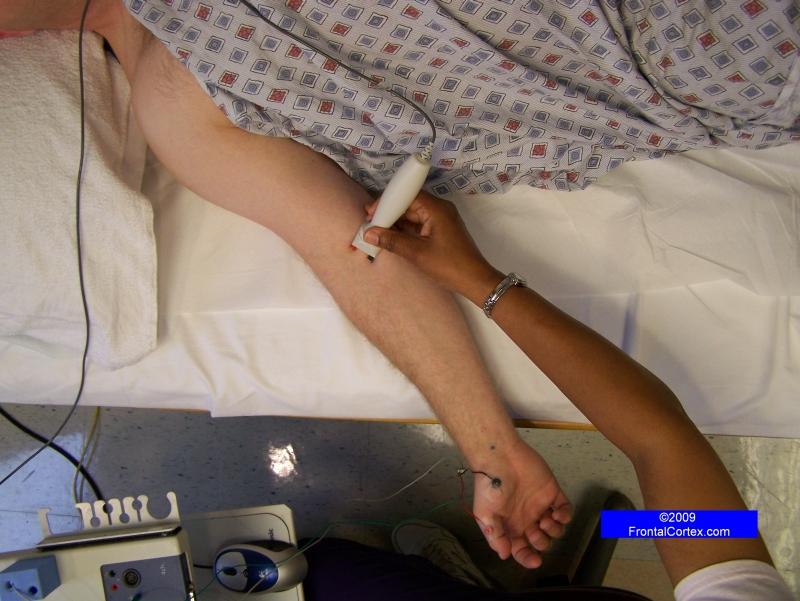Median Motor Nerve Conduction Study - Recording Abductor Pollicis Brevis, Stimulating at Elbow