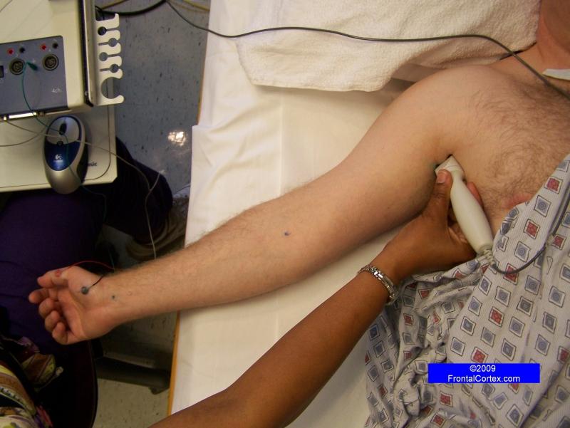 Median Motor Nerve Conduction Study - Recording Abductor Pollicis Brevis, Stimulating at Axilla