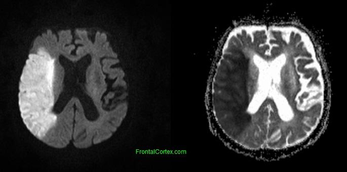 MRI acute right MCA stroke