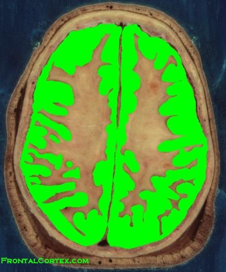 Brain Horizontal Cortex highligh