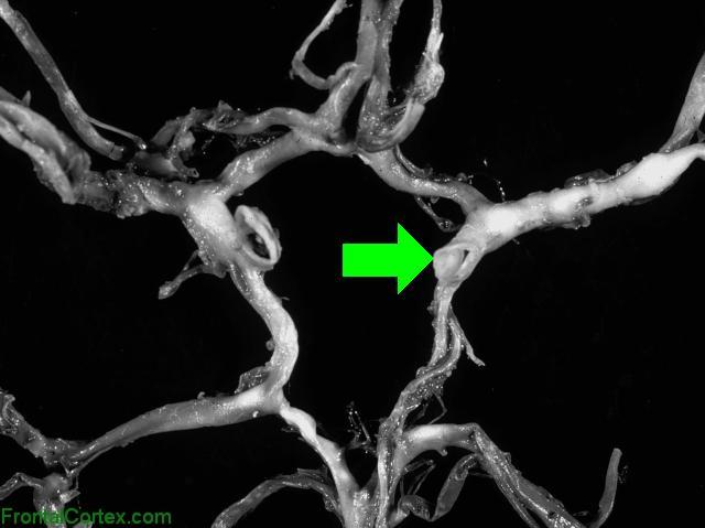 Circle of Willis Dissected - ICA