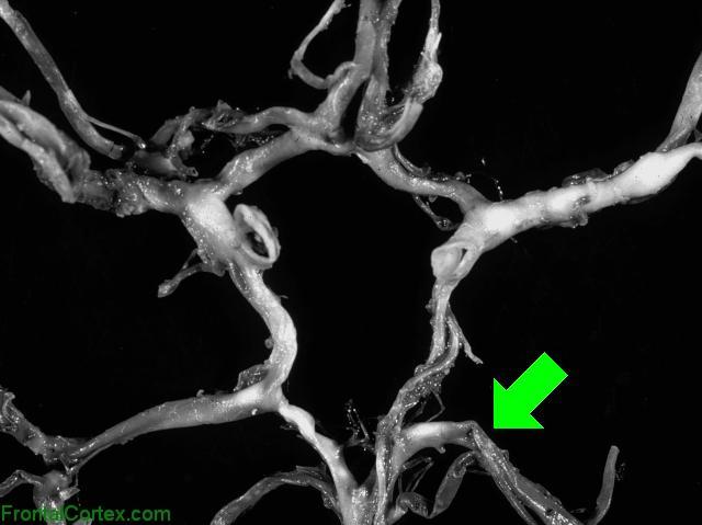 Circle of Willis Dissected - PCA