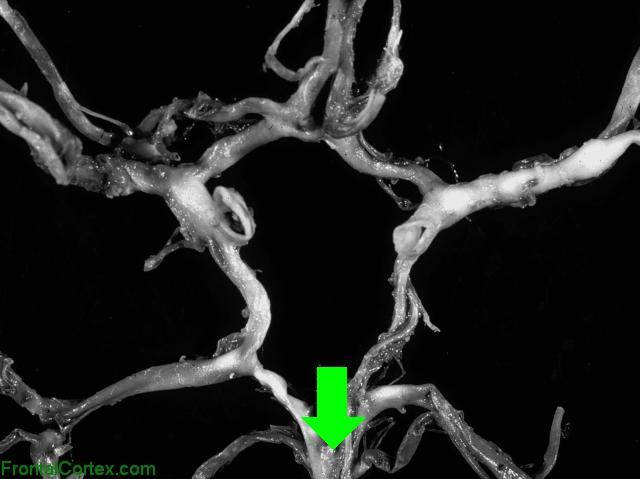 Circle of Willis Dissected - bas