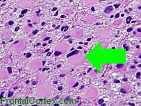 Gemistocytic Astrocytoma H&E wit