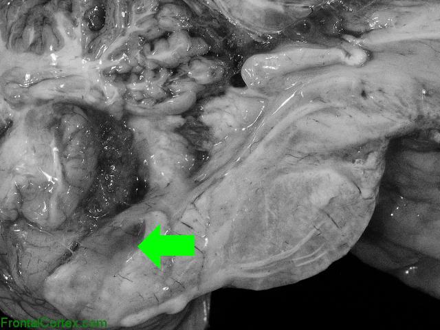 Longitudinally extensive transverse myelitis, extending into caudal brainstem, mid sagittal section of brain with arrow