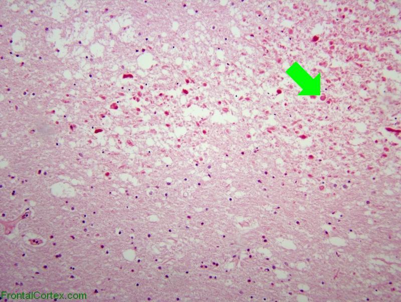 Methotrexate neurotoxicity, H&E stained section x 100 with arrow