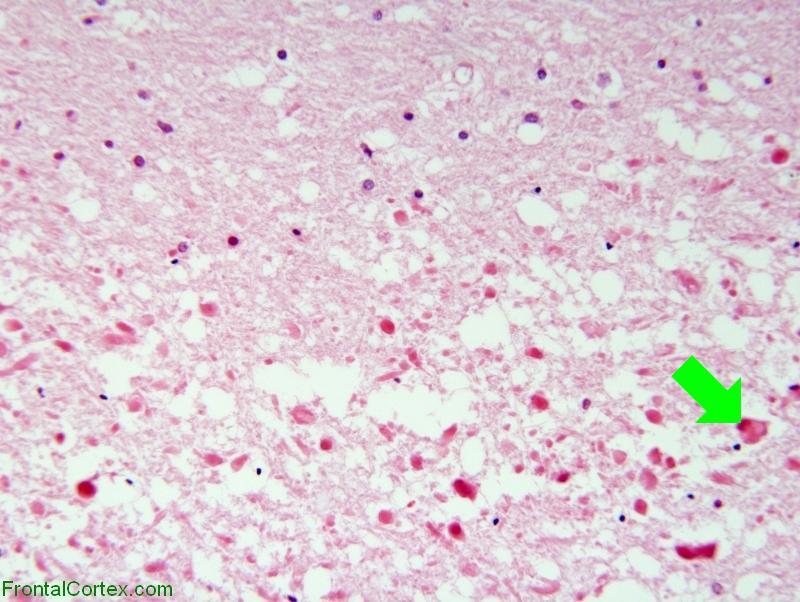 Methotrexate neurotoxicity, H&E stain section, high power with arrow