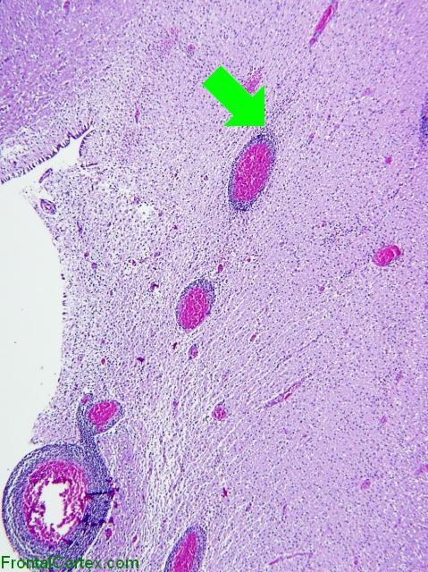 Active demyelinative plaque, periventricular region, H&E stain x 40 with arrow
