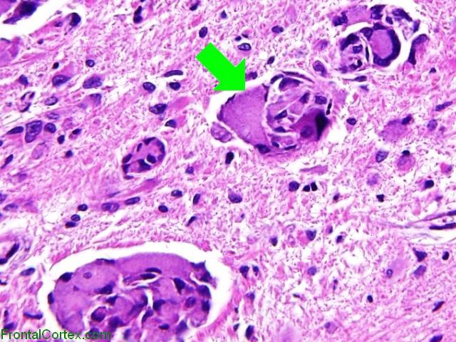 Krabbe disease, H&E stained section, high power with arrow