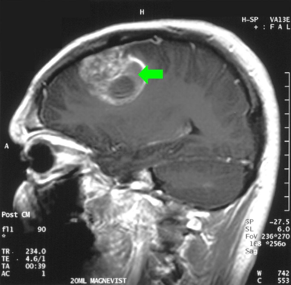 GBM - MRI with contrast sagittal with arrow