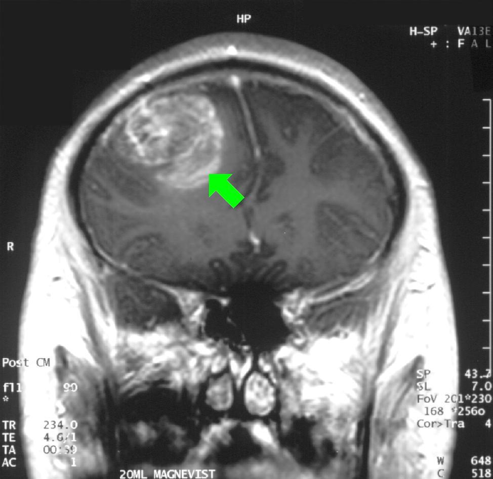 GBM - MRI with contrast with arrow