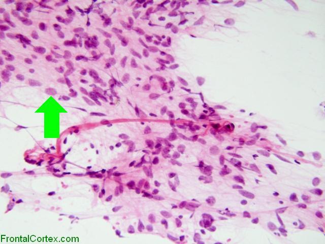 Glioblastoma multiforme, intraop