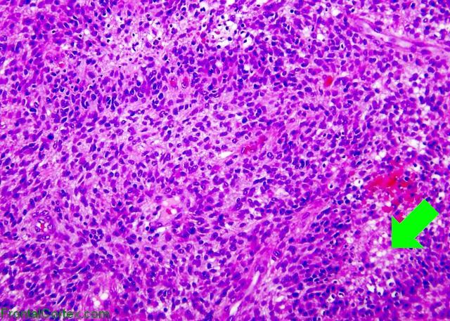 Glioblastoma multiforme, small cell variant, H&E stain x 200 with arrow