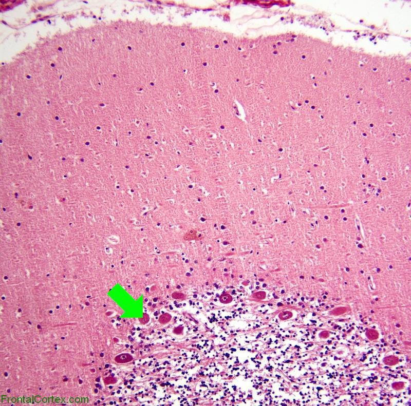 For comparison, normal adult cerebellum with arrow