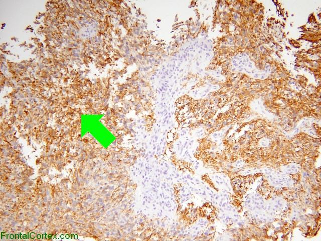 GFAP staining - Example of pathological findings