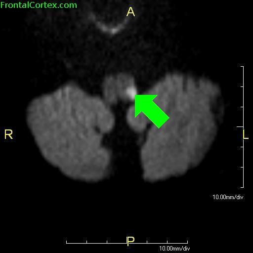 Wallenberg Syndrome MRI with arrow