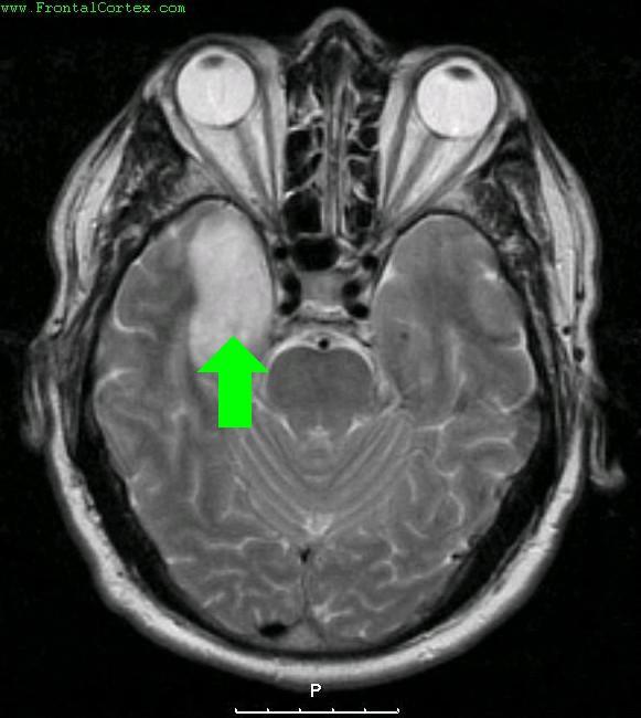 Viral Encephalitis - MRI with arrow