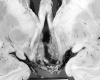 Craniopharyngioma001