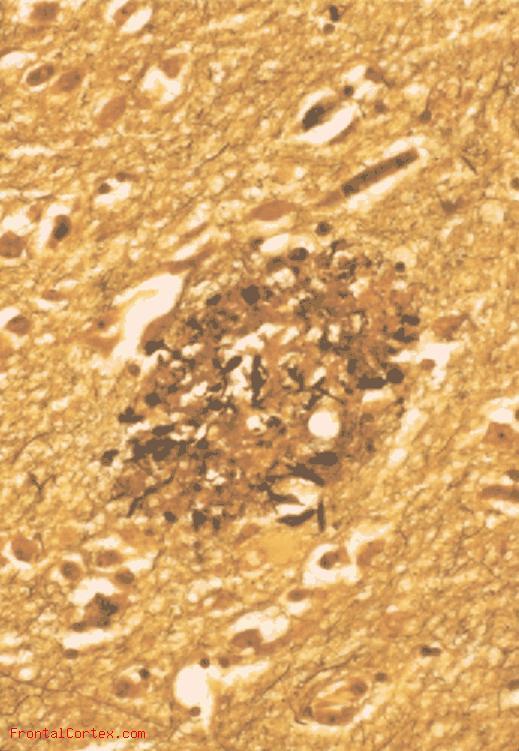 Amyloid Plaque NIA