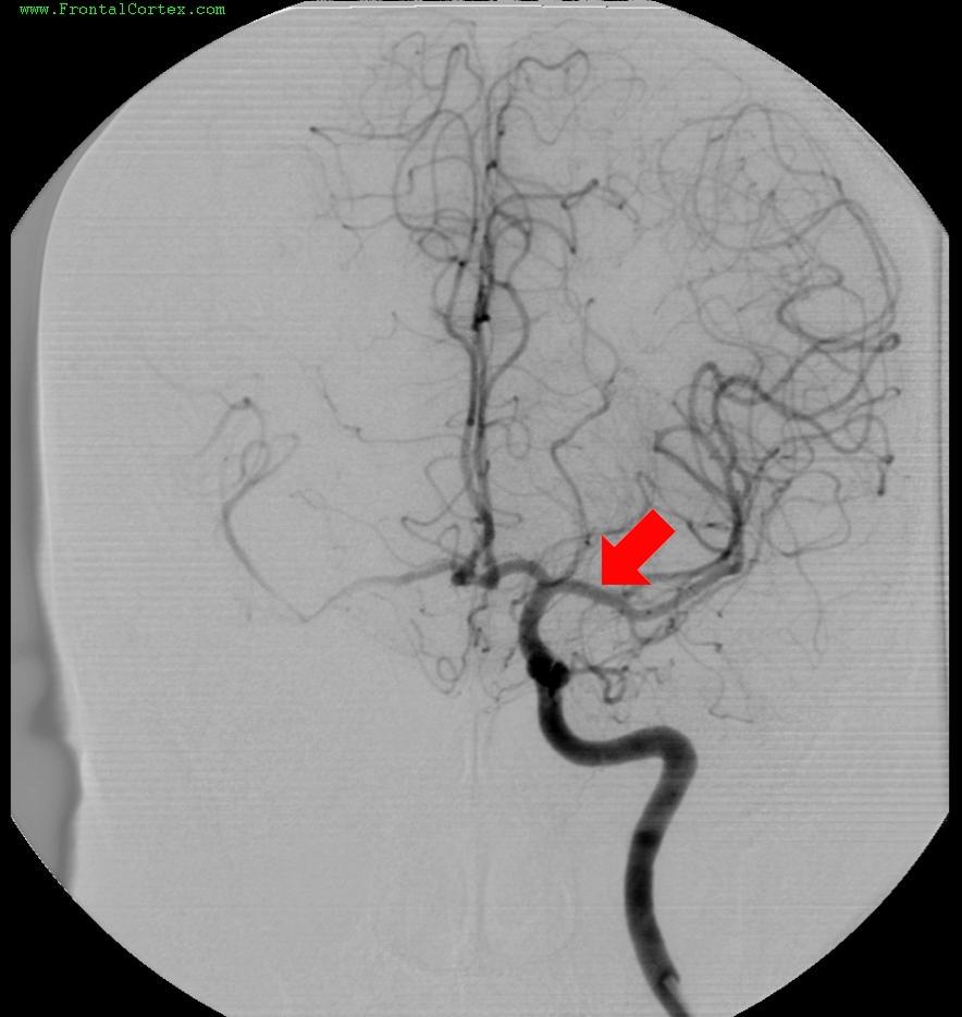 Angiogram 2 MCA M1